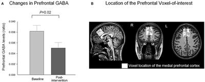 Changes in Prefrontal Gamma-Aminobutyric Acid and Perfusion After the Computerized Relaxation Training in Women With Psychological Distress: A Preliminary Report